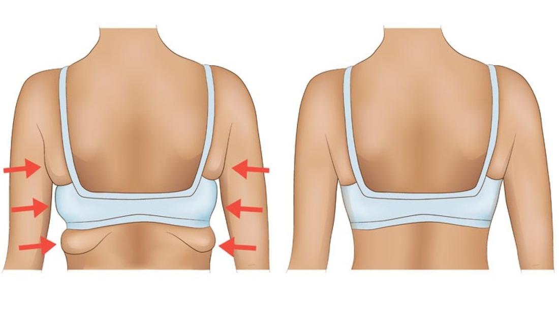 أفضل طريقة للتخلص من دهون الظهر.. كيف ازيل دهون الظهر بسرعه؟
