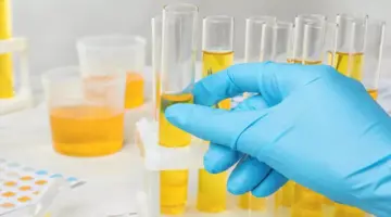 معنى Pus Cells في تحليل البول