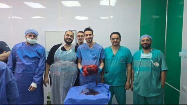 نجاح طبي كبير في المنوفية: استئصال ورم ضخم يزن 30 كيلو جرام من بطن شاب